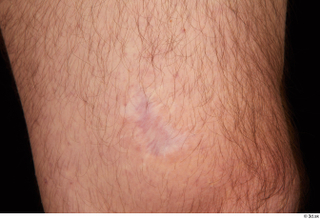 Orest nude scar skin 0001.jpg